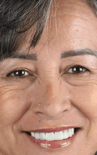 Depois: paciente de implante dentário da Clínica Vita Implantes