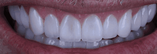 Depois: sorriso de paciente de lentes de contato dental da Clínica Vita Implantes